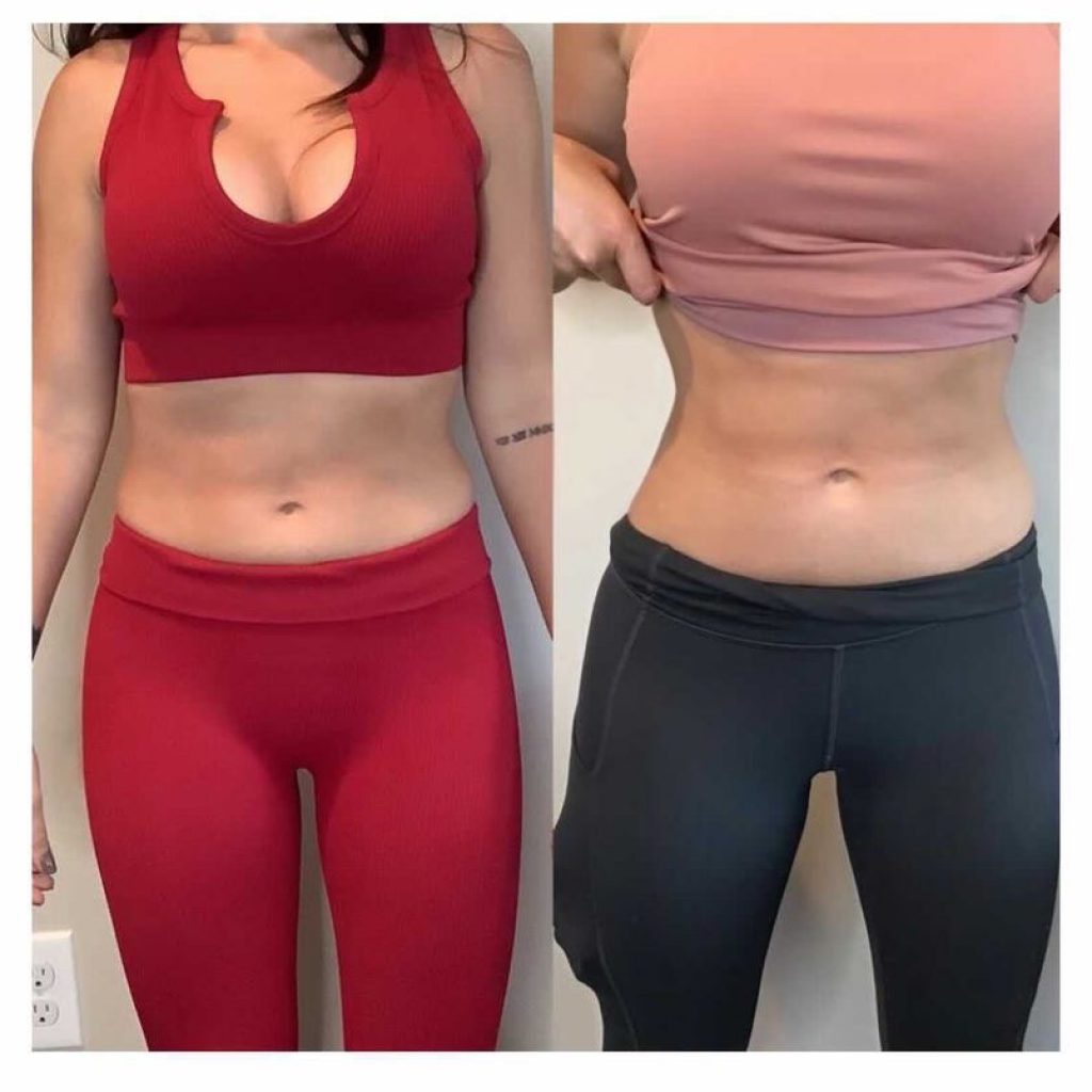 Emsculpt NEO for Abs & Abdomen Before & After
